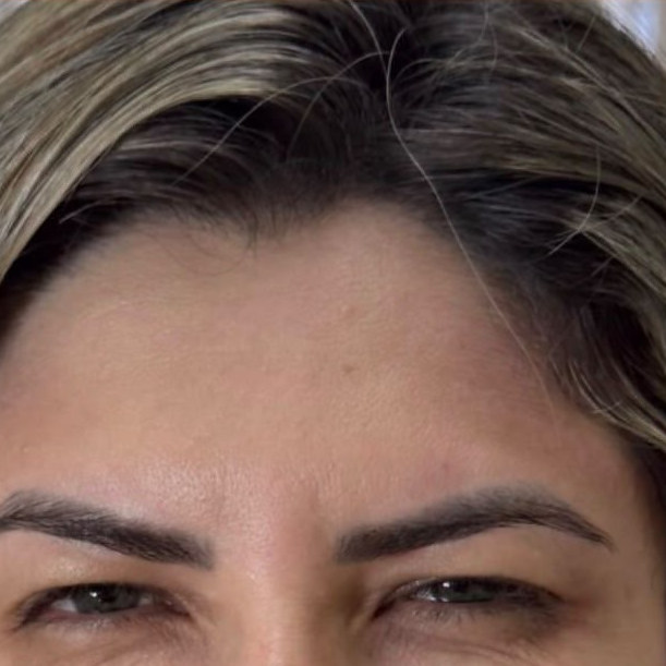 Resultado de paciente, depois do procedimento